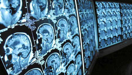 Nueva prueba identifica el riesgo de Alzheimer con 90% de exactitud