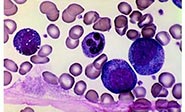Convierten c&eacute;lulas de cáncer en inofensivos glóbulos blancos