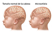 El primer caso de microcefalia en Espa&ntilde;a  a causa del Zika